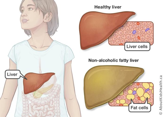 The Unfortunate Link Between Fatty Liver Disease and Latino Kids | BELatina