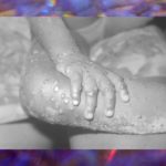 ‘This Is Nothing Like COVID,’ What You Need to Know About Monkeypox Monkeypox BELatina Latinx