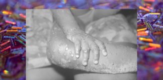 ‘This Is Nothing Like COVID,’ What You Need to Know About Monkeypox Monkeypox BELatina Latinx